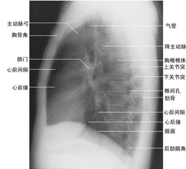 2010年医学影像学实践技能辅导:胸部侧位图